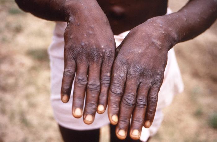 who-calls-for-‘urgent’-action-in-europe-over-monkeypox
