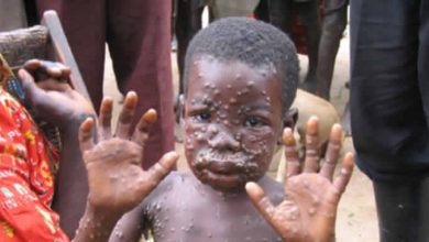 kwara-confirms-first-case-of-monkeypox