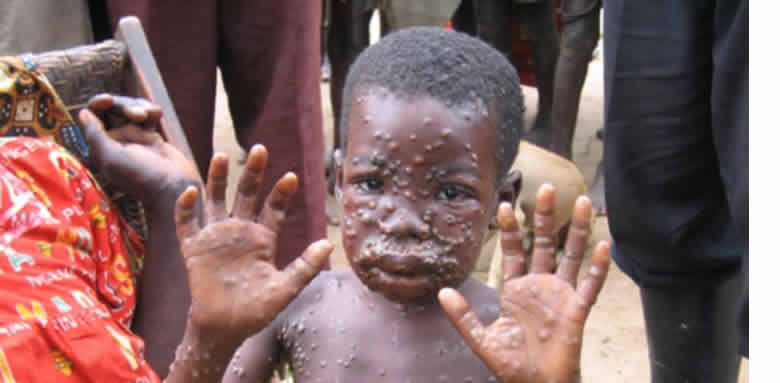 monkeypox-cases-rise-to-157-in-nigeria