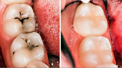 3-home-remedies-for-tooth-decay-and-cavities