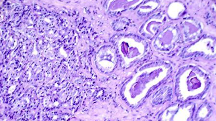 scientists-identify-‘genetic-signatures’-holding-clues-on-link-between-prostate-cancer-and-ethnic-background