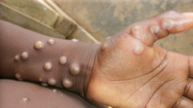 egypt-reports-first-monkeypox-case