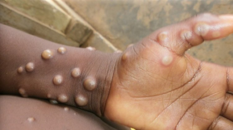 egypt-reports-first-monkeypox-case