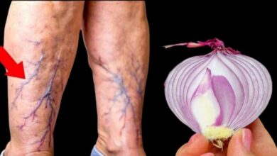 onions:-a-natural-remedy-for-varicose-veins