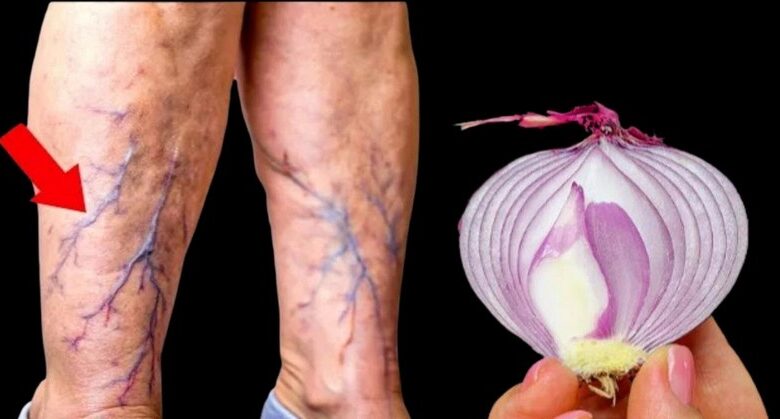 onions:-a-natural-remedy-for-varicose-veins