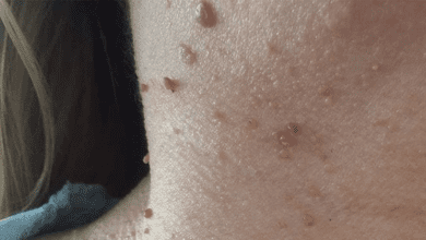 what-are-the-best-natural-ways-to-remove-moles-from-the-skin?