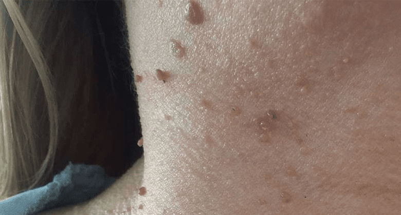 what-are-the-best-natural-ways-to-remove-moles-from-the-skin?