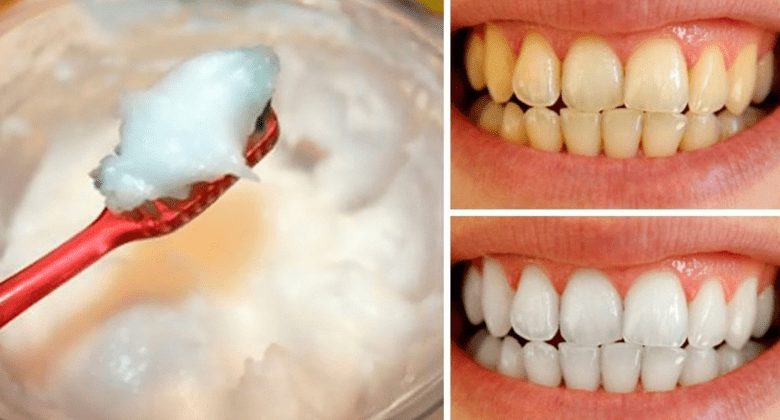 how-to-naturally-whiten-your-teeth-at-home-using-baking-soda-and-coconut-oil