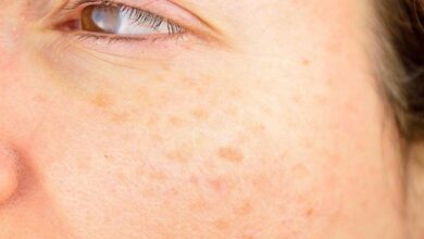 this-vitamin-can-remove-age-spots-(very-effective!)