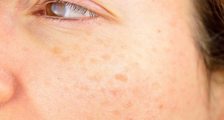 this-vitamin-can-remove-age-spots-(very-effective!)