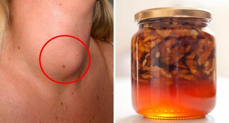 improve-your-thyroid-gland-function-with-this-honey-and-walnuts-recipe