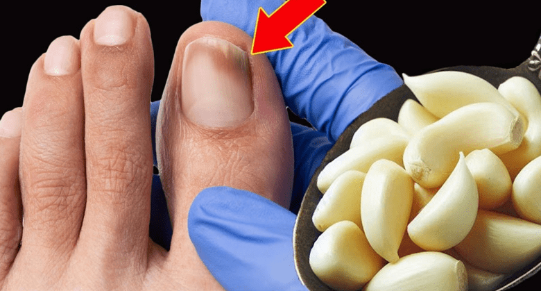 this-is-a-solution-for-nail-fungus-(it-works-very-fast):-garlic!