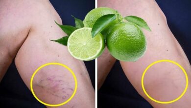 lemon-removes-varicose-veins!-just-do-this-before-bed…