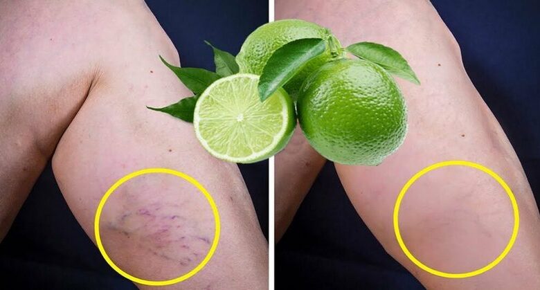 lemon-removes-varicose-veins!-just-do-this-before-bed…