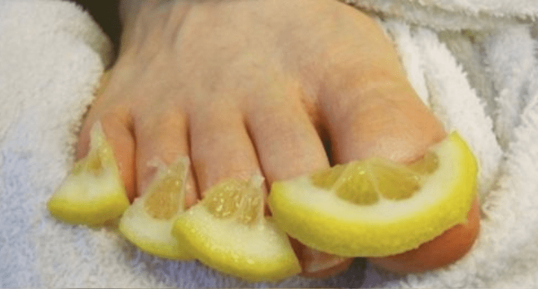 lemon:-a-natural-remedy-for-combating-toenail-fungus