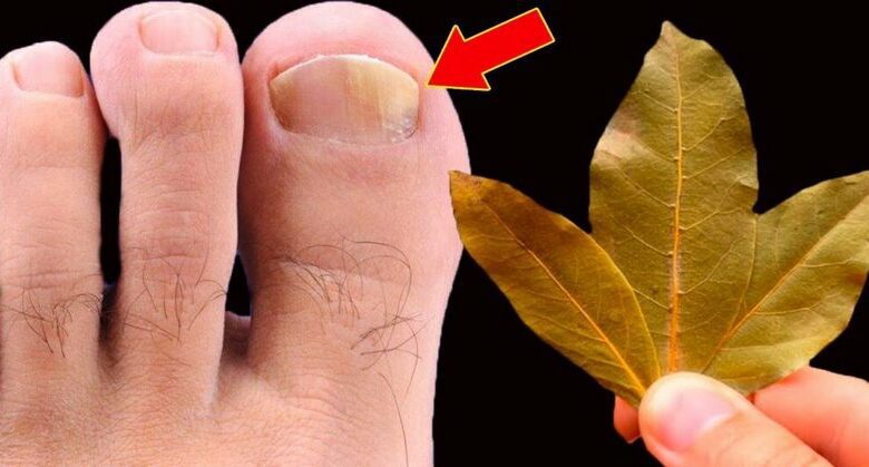 get-rid-of-nail-fungus-with-just-bay-leaves!-you-don’t-need-to-spend-extra-money-at-the-pharmacy!