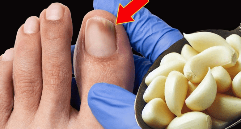 this-is-a-nail-fungus-ki*ller-(it-works-fast):-garlic!