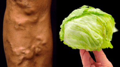 amazing-remedy-for-varicose-veins:-cabbage-leaves