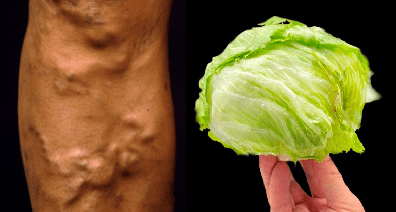 amazing-remedy-for-varicose-veins:-cabbage-leaves