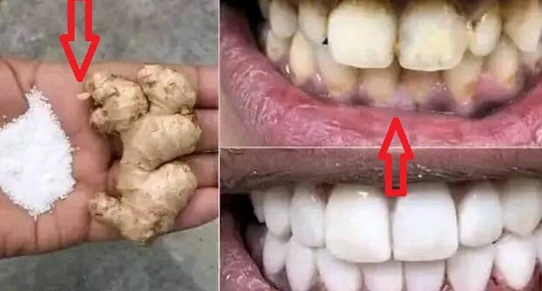 transform-your-smile:-the-ultimate-teeth-whitening-method-unveiled