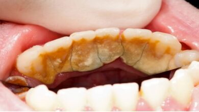 how-do-you-remove-strong-tartar-from-teeth?