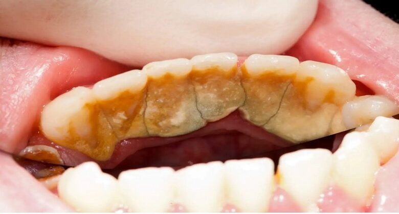 how-do-you-remove-strong-tartar-from-teeth?