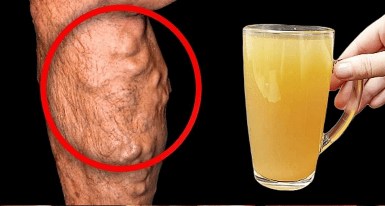 apple-and-lemon-juice-quickly-dissolve-blood-clots-and-make-the-blood-fluid!