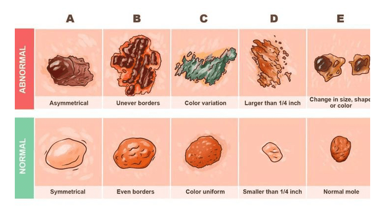 skin-cancҽr-detector-guide