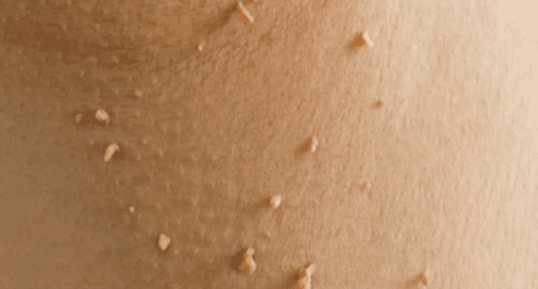 skin-tags-&-plantar-warts-disappear-overnight?