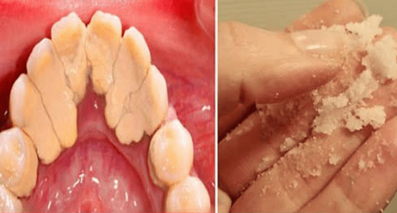 home-remedies-to-get-rid-of-plaque-and-tartar