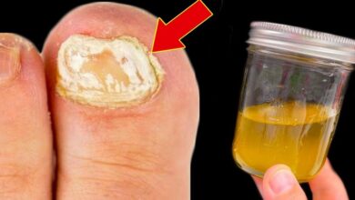 a-simple-and-effective-natural-remedy-for-nail-fungus