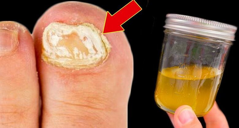 a-simple-and-effective-natural-remedy-for-nail-fungus