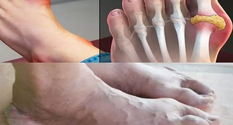 the-no.-1-mineral-for-preventing-gout:-magnesium