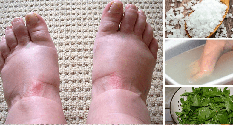 home-remedies-for-swollen-feet