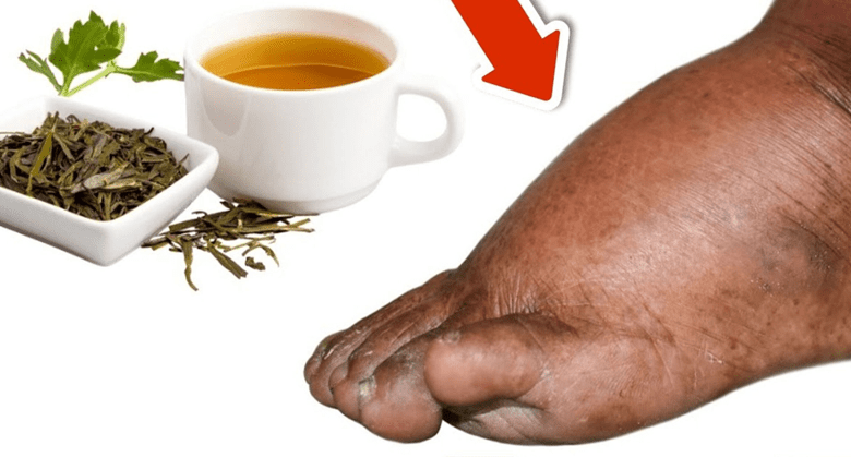 sip-away-swelling:-discover-the-herbal-tea-that-soothes-swollen-legs,-ankles,-and-feet