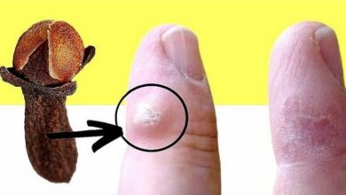 using-cloves-to-remove-warts:-a-simple-method