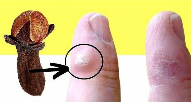 using-cloves-to-remove-warts:-a-simple-method