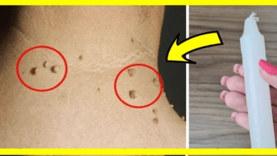 how-to-remove-warts-with-a-candle:-a-home-remedy