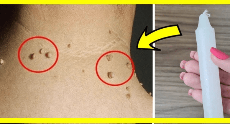 how-to-remove-warts-with-a-candle:-a-home-remedy