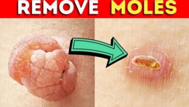 how-to-remove-a-mole-quickly-using-castor-oil