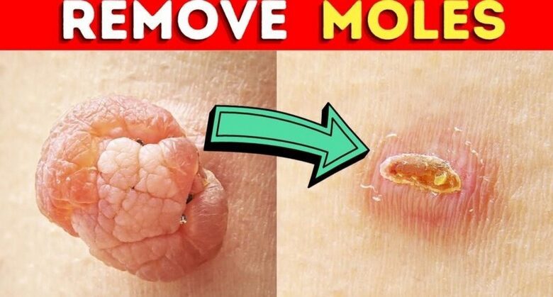 how-to-remove-a-mole-quickly-using-castor-oil