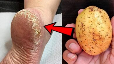 remove-cracked-heels-and-get-smooth,-white-feet-with-magic-potato-home-remedy