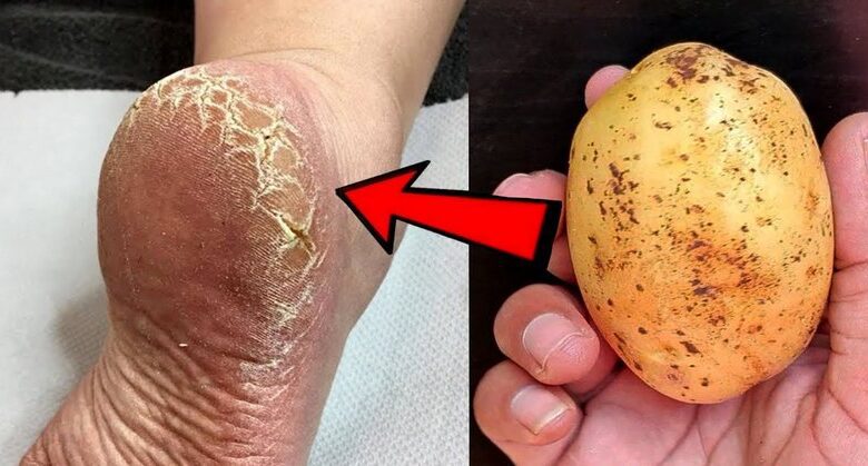 remove-cracked-heels-and-get-smooth,-white-feet-with-magic-potato-home-remedy