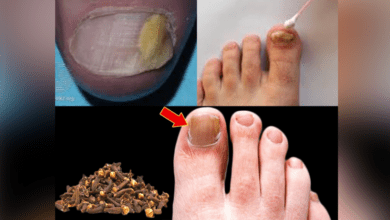 clove-oil:-a-natural-remedy-for-nail-fungus