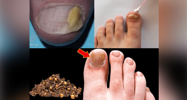 clove-oil:-a-natural-remedy-for-nail-fungus