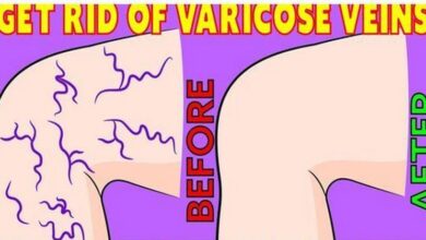 natural-ways-to-reduce-varicose-veins-with-a-simple-daily-routine