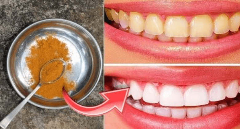 secret-that-dentists-don’t-want-you-to-know:-remove-tartar-and-whiten-teeth-using-turmeric