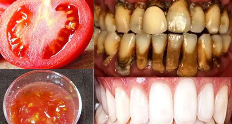 the-strongest-teeth-whitening-recipe-at-home-in-2-minutes:-whitening-yellow-teeth-from-tartar-naturally-with-tomatoes-and…-