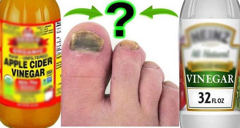 white-vinegar-vs.-apple-cider-vinegar-for-toenail-fungus:-which-is-better?