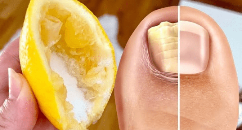 nail-fungus-removal:-natural-treatment-for-toenail-fungus-with-lemon-and-salt